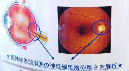 網膜のCTともいえる　OCT3